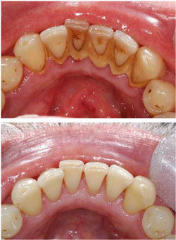teeth polish clean gums lower gum deterioration bone calculus tissue cleaning bad dental